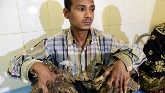 Surgery for Bangladesh`s `Tree Man` to remove warts